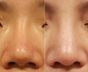 圖／左：矽膠隆鼻術後出現攣縮歪斜，鼻梁過細的問題。右：採用全Goretex鼻模及結構式隆鼻重修。