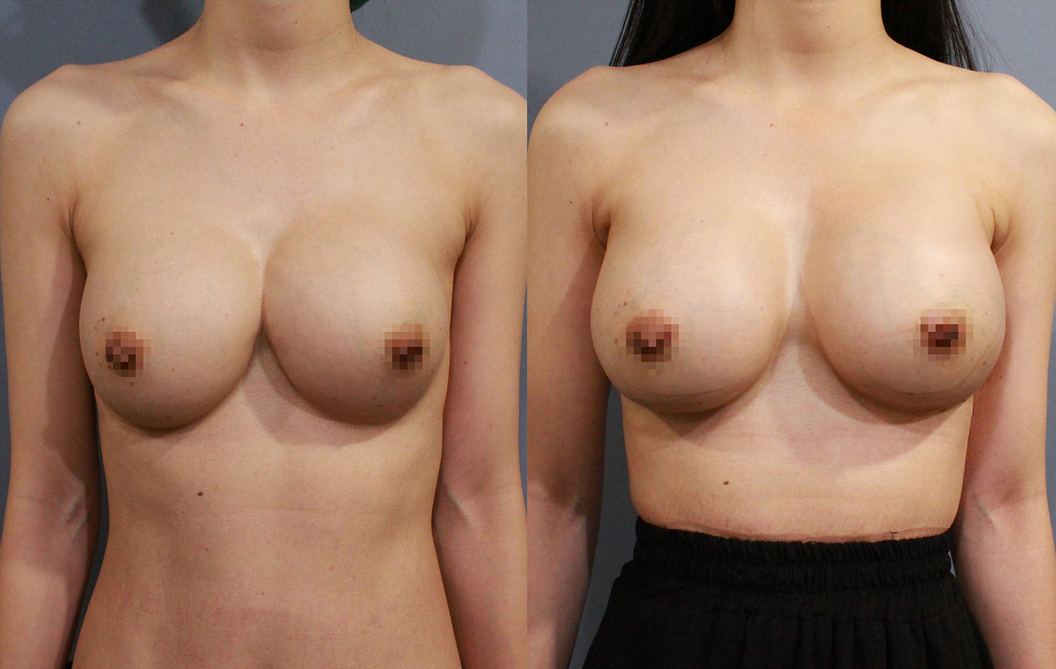 左圖：客人之前接受傳統隆乳術後造成兩邊胸部相連的不自然結果。右圖：經過全程內視鏡，並使用魔滴假體隆乳的方式來矯正融合胸的問題，並得到很好的效果