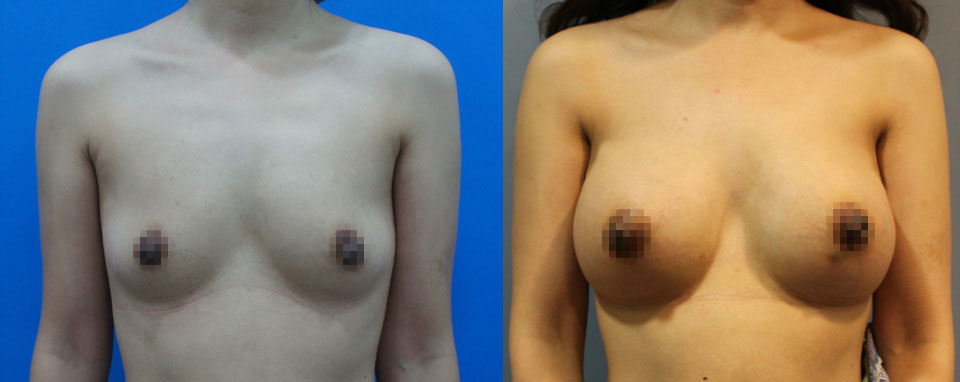 果凍矽膠隆乳。左：術前；右：術後