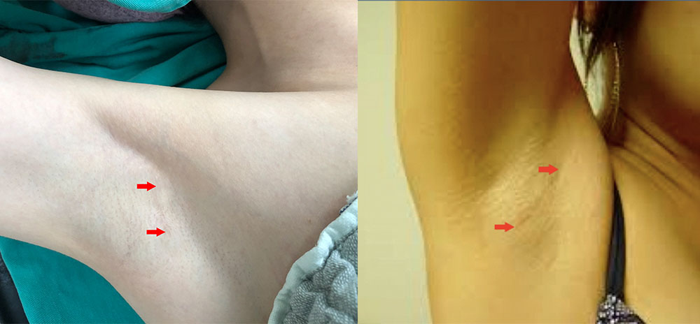 左：經腋下Motiva魔滴隆乳；右：經腋下水滴型果凍隆乳。比較之下明顯Motiva魔滴可以縮短手術傷口